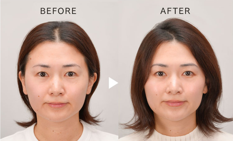 イオン電気針ヘッドスパで、髪のハリや立ち上がりを実感