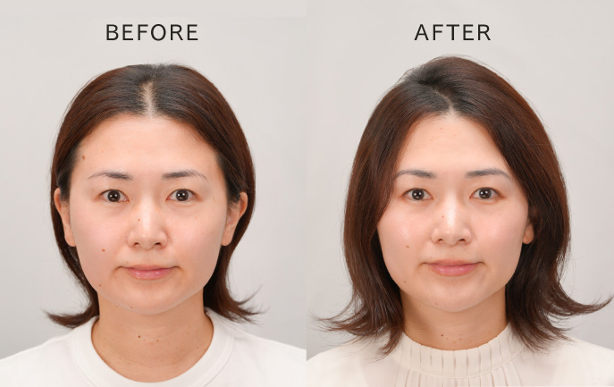 イオン電気針ヘッドスパで、髪のハリや立ち上がりを実感