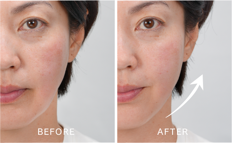 イオン電気針ヘッドスパの使用によるフェイスラインの変化