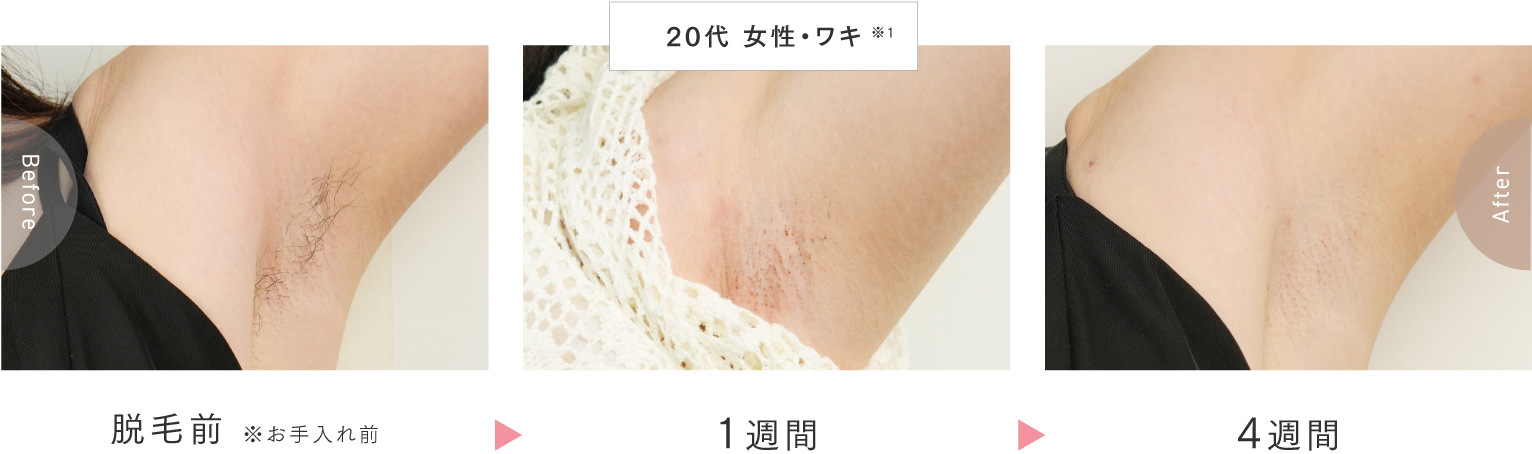 MiRAY AIRは最短1週間で脱毛効果を実感